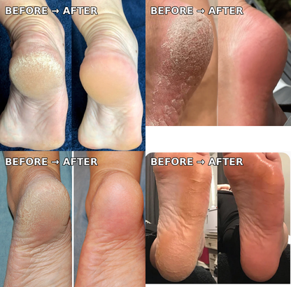 Electric Pedicure Foot File & Callus Remover